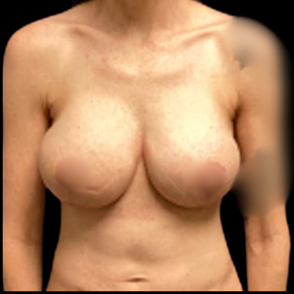 Breast Augmentation Before & After Patient #5431