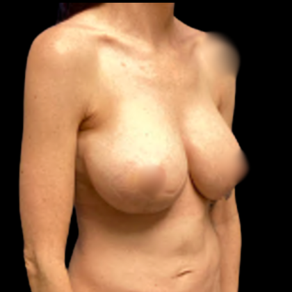 Breast Augmentation Before & After Patient #5431