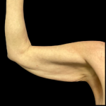 Arm Lift Before & After Patient #5461