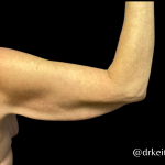 Arm Lift Before & After Patient #5461