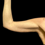 Arm Lift Before & After Patient #5461