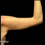 Arm Lift Before & After Patient #5461