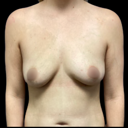 Breast Augmentation Before & After Patient #5463