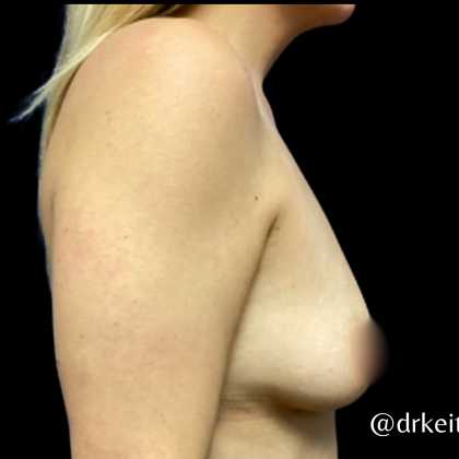 Breast Augmentation Before & After Patient #5463