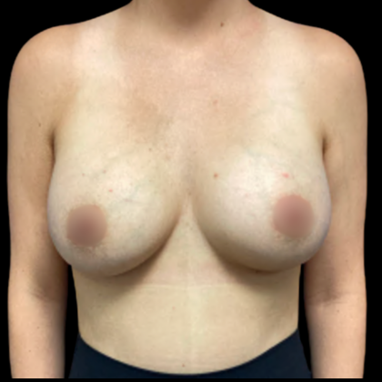 Breast Augmentation Before & After Patient #5463