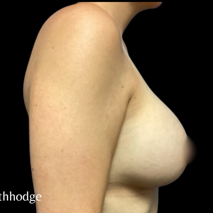 Breast Augmentation Before & After Patient #5463