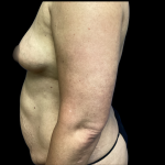 Breast Augmentation Before & After Patient #5462