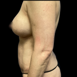 Breast Augmentation Before & After Patient #5462