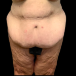 Tummy Tuck Before & After Patient #5432