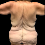 Tummy Tuck Before & After Patient #5432