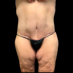 Tummy Tuck Before & After Patient #5432