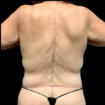 Tummy Tuck Before & After Patient #5432