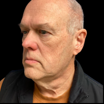 Facelift Before & After Patient #5465