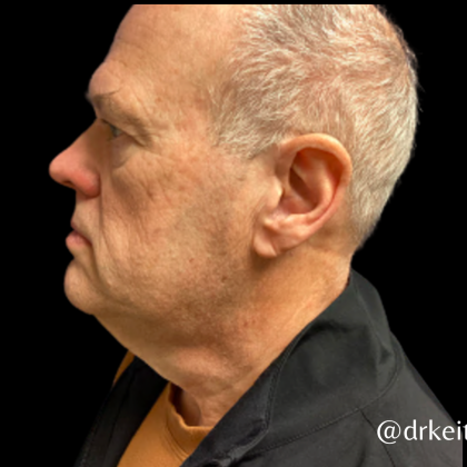 Facelift Before & After Patient #5465