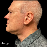 Facelift Before & After Patient #5465
