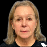 Facelift Before & After Patient #5466