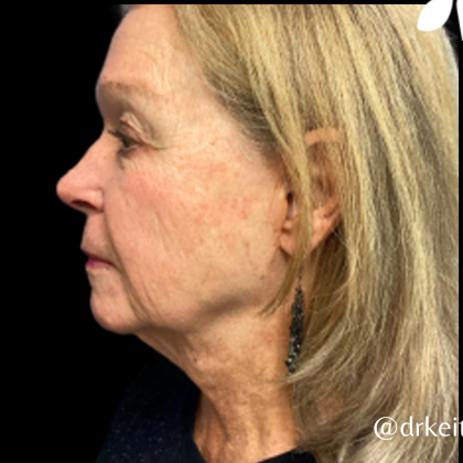 Facelift Before & After Patient #5466