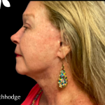 Facelift Before & After Patient #5466