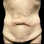 Tummy Tuck Before & After Patient #5467