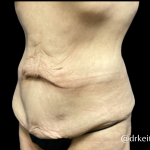 Tummy Tuck Before & After Patient #5467