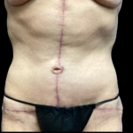Tummy Tuck Before & After Patient #5467