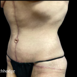 Tummy Tuck Before & After Patient #5467