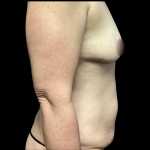 Mommy Makeover Before & After Patient #5469