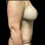 Mommy Makeover Before & After Patient #5469