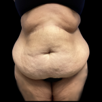 Tummy Tuck Before & After Patient #5470