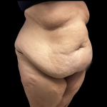 Tummy Tuck Before & After Patient #5470