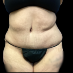 Tummy Tuck Before & After Patient #5470