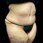 Tummy Tuck Before & After Patient #5470