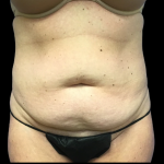 Tummy Tuck Before & After Patient #5458