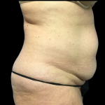 Tummy Tuck Before & After Patient #5458