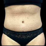 Tummy Tuck Before & After Patient #5458