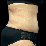 Tummy Tuck Before & After Patient #5458