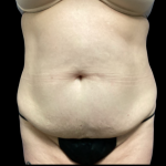 Tummy Tuck Before & After Patient #5459