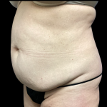 Tummy Tuck Before & After Patient #5459