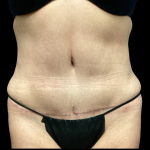 Tummy Tuck Before & After Patient #5459