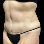 Tummy Tuck Before & After Patient #5459