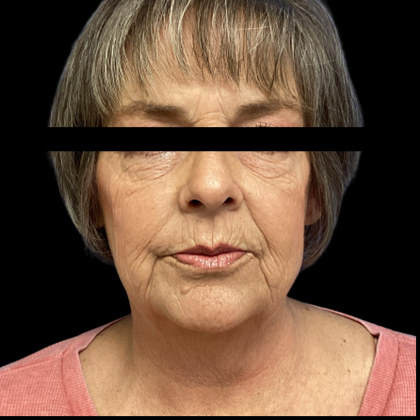 Facelift Before & After Patient #5464