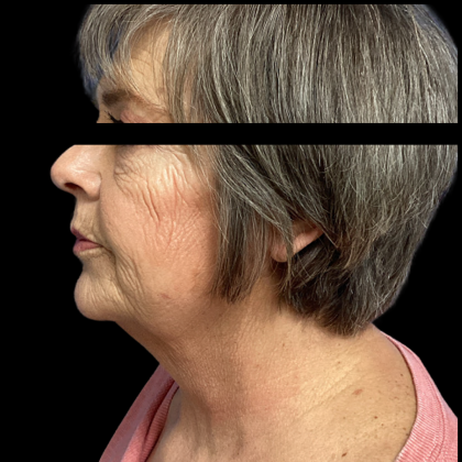 Facelift Before & After Patient #5464