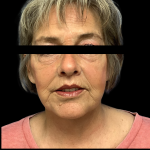 Facelift Before & After Patient #5464