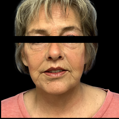 Facelift Before & After Patient #5464