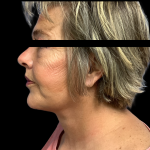 Facelift Before & After Patient #5464