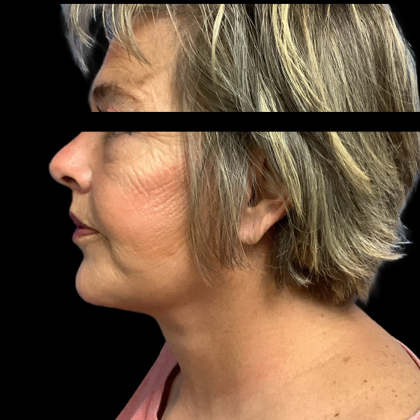 Facelift Before & After Patient #5464