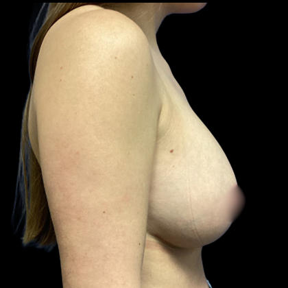 Breast Augmentation Before & After Patient #5468