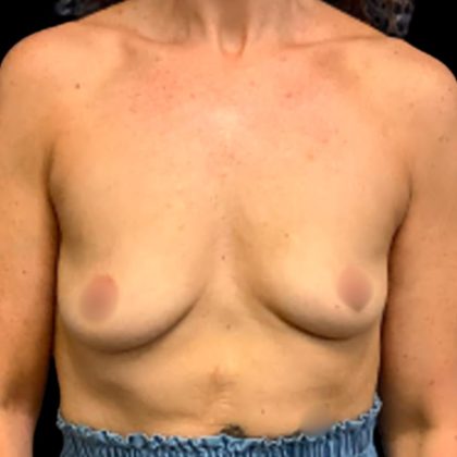 Breast Augmentation Before & After Patient #5598
