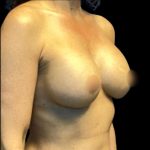 Breast Augmentation Before & After Patient #5596