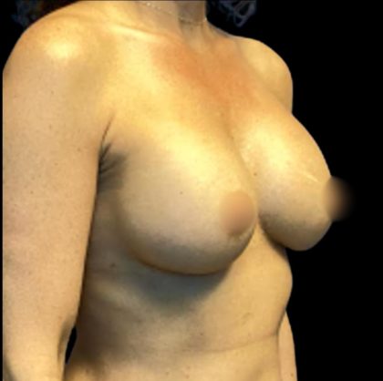 Breast Augmentation Before & After Patient #5596